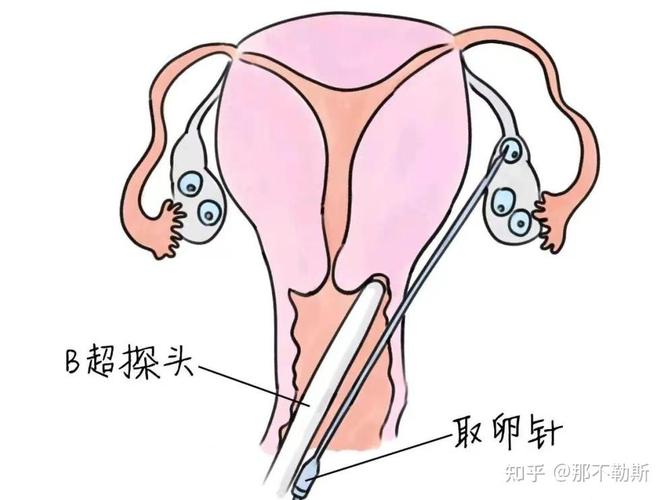 广西做试管婴儿的医院_广西做试管最好_广西三代试管 PGT 费用 参考