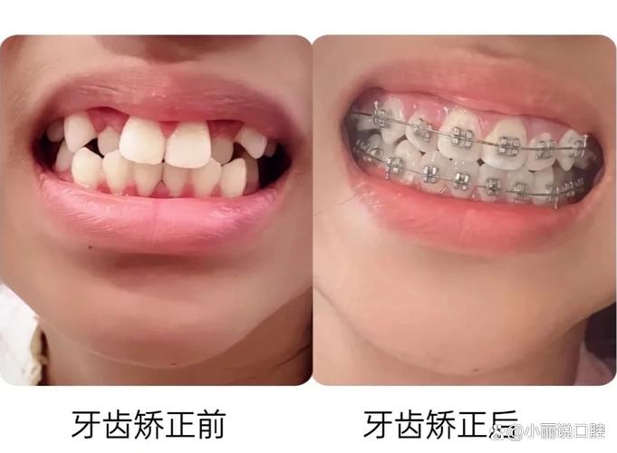 15岁牙齿不齐怎么办 专家说三种矫正方式哪种最适合你