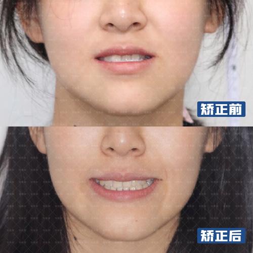纠正牙齿步骤是什么_26岁纠正牙齿还来得及吗_纠正牙齿好还是不好