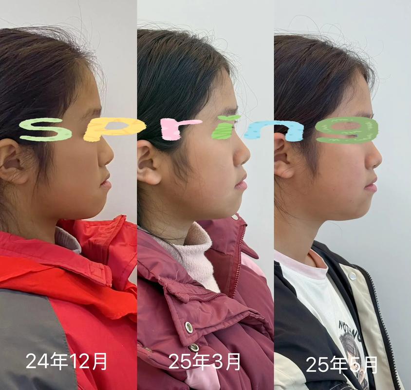 牙齿矫正可以矫正地包天吗_地包天牙齿能纠正吗_正畸可以改变地包天吗