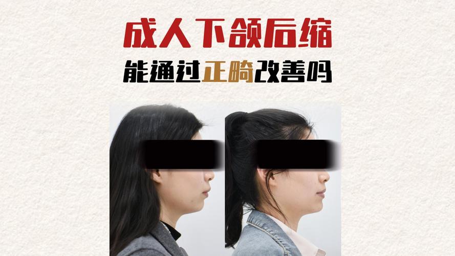 矫正牙齿可以改变下巴后缩吗_缩下巴牙齿矫正改变可以后移吗_牙齿矫正下巴后缩需要多长时间