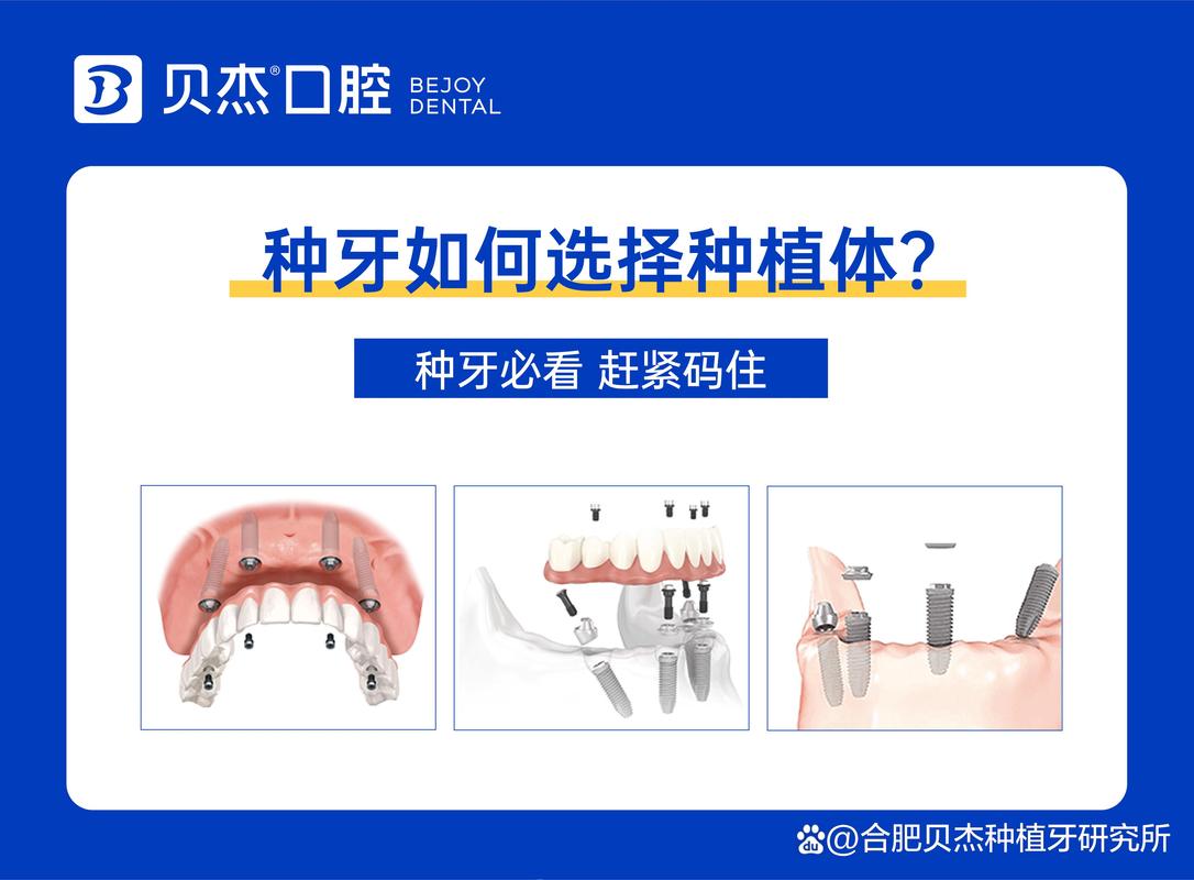 种植牙品牌怎么选 预算 / 骨量匹配_种植牙骨量怎么看_种植牙要求的骨量