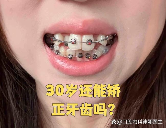 成年人也能做矫正 牙齿年龄限制真相大揭秘