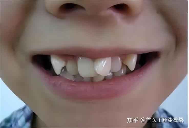 深圳儿童地包天最佳矫正年龄是多少？别等换牙误了大事