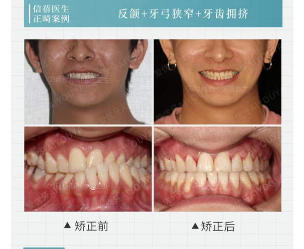 深圳中学生牙齿矫正优惠活动真的靠谱吗？