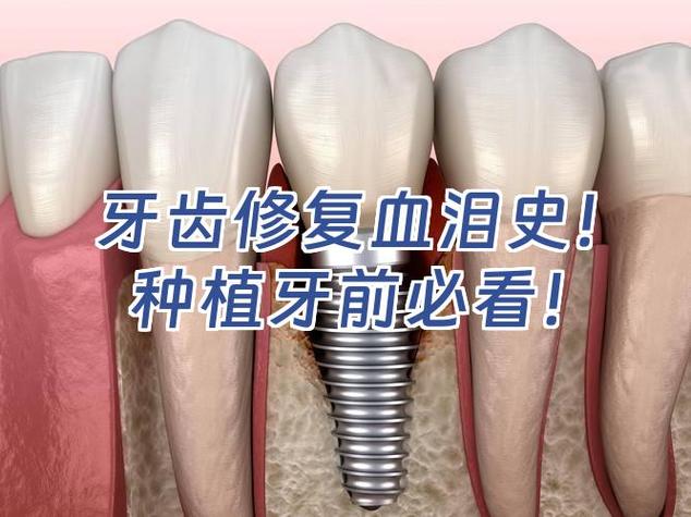 种植牙失败了怎么办 修复费用要多少才合理