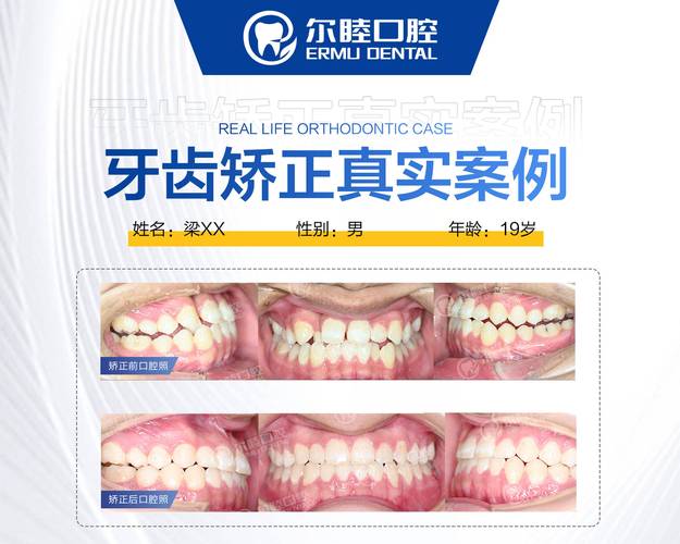深圳福田青少年钢丝正畸费用要多少钱？