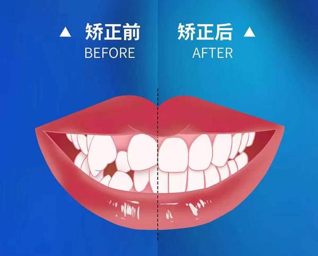 曲靖牙齿矫正需要多久_牙齿矫正曲靖需要多少钱_矫正牙齿所需材料