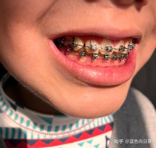 成人矫正牙齿_矫正牙齿_德阳牙齿矫正多少钱