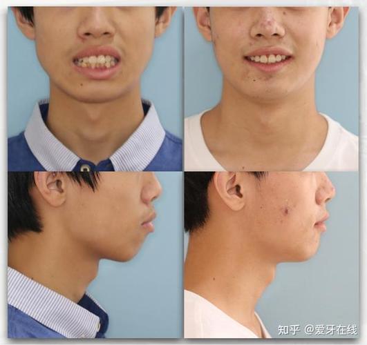 呼和浩特牙齿矫正效果怎么样_呼和浩特正畸医院排名_呼和浩特正畸哪家好