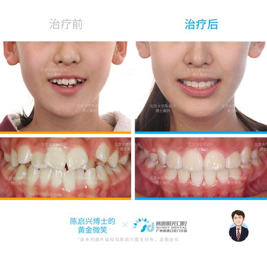 呼和浩特正畸医院排名_呼和浩特牙齿矫正效果怎么样_呼和浩特正畸哪家好
