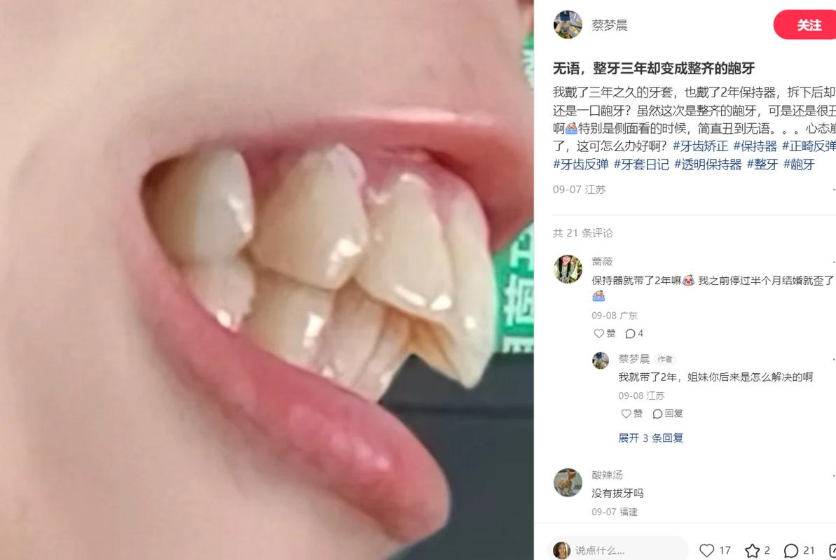 矫正牙齿反弹了还能再矫正吗_反弹牙齿矫正容易松动吗_35矫正牙齿容易反弹吗