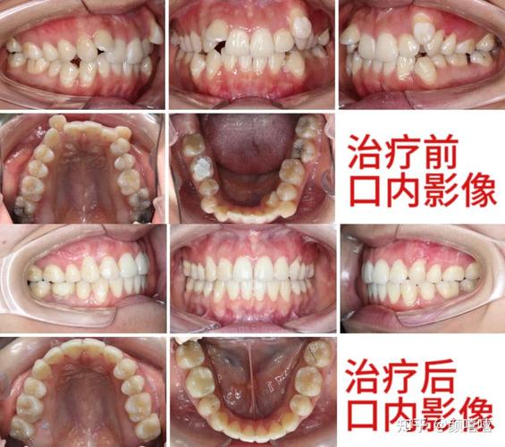 牙齿必须矫正_36岁牙齿矫正有必要吗_牙齿矫正到底有没有必要