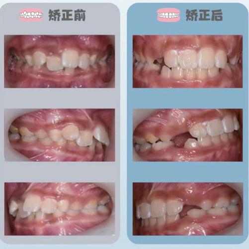 牙齿矫正孩子什么时候最好_牙齿矫正孩子最佳年龄_孩子几岁矫正牙齿