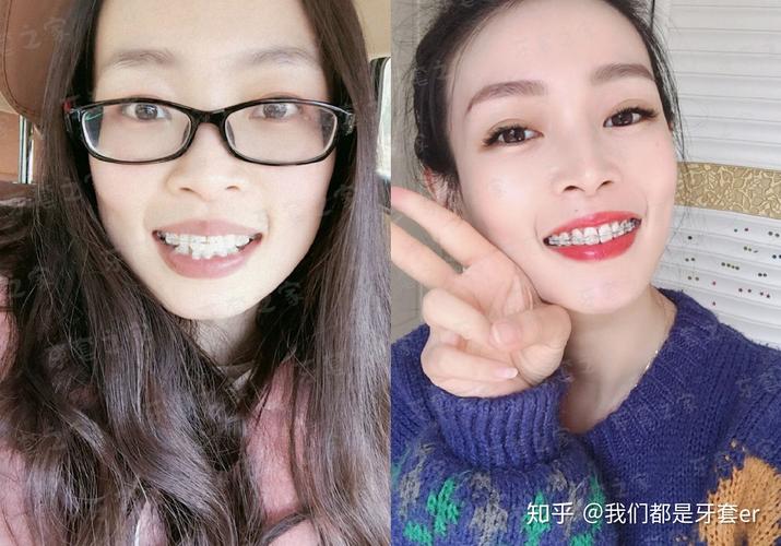 牙齿矫正行业存在痛点_牙齿矫正亲身经历_40多岁牙齿矫正行吗