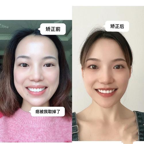 成年人牙齿矫正还来得及吗