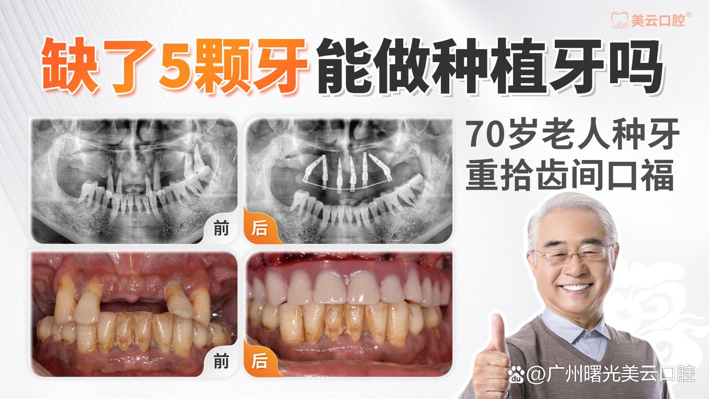 种牙可以做牙齿矫正吗_种牙能行吗_70多岁可以种牙吗