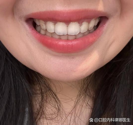 23岁牙不齐还能整吗？正畸黄金期过了没