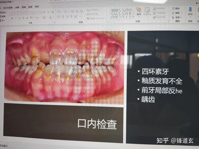 牙齿矫正能还价吗_牙齿矫正钱要可以用医保吗_24岁可以矫正牙齿要多少钱
