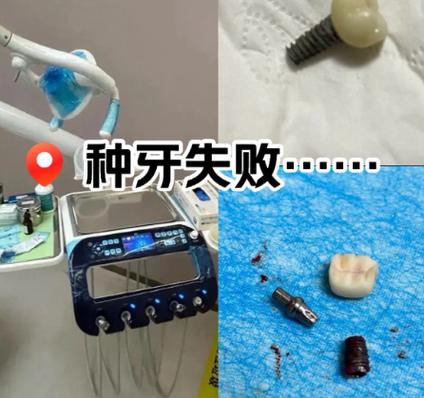 法国的种植牙齿怎么样_法国种植牙多少钱一颗_法国种植牙X3
