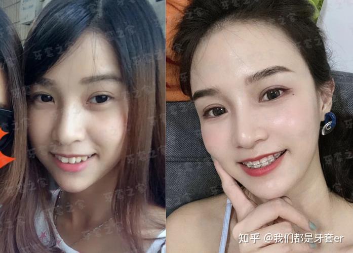 牙齿矫正要多少钱2026年_43岁矫正深覆合牙齿要多少钱_牙齿矫正费用可以分期吗