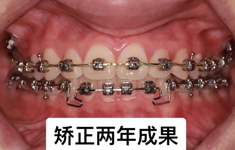 牙齿矫正费用可以分期吗_牙齿矫正要多少钱2026年_43岁矫正深覆合牙齿要多少钱