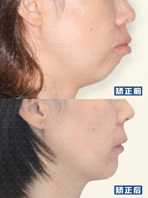 矫正牙齿能改善下巴后缩吗？3个关键问题正畸医生一次说清