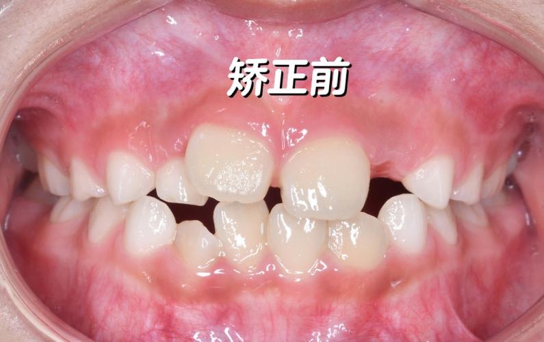 牙齿矫正能用医保报销吗_11岁能矫正牙齿吗_牙齿矫正能走医保吗