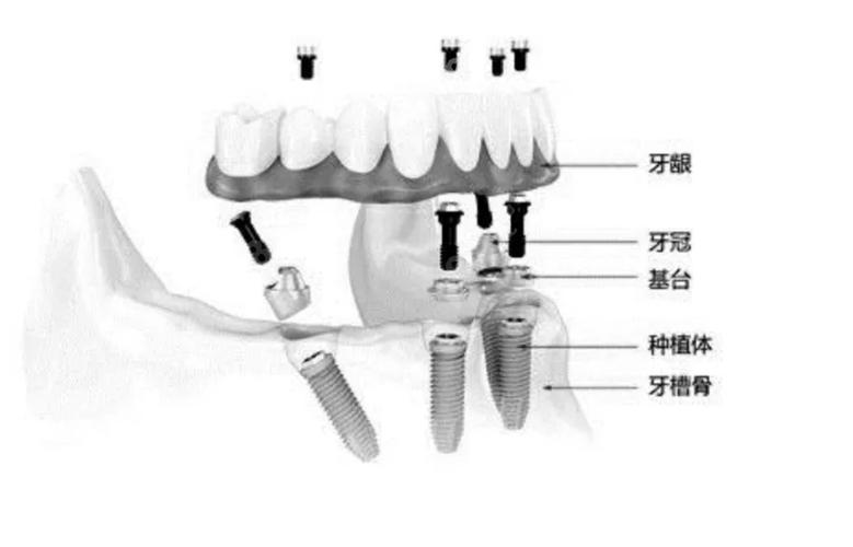 半口种牙费用不固定 一颗大概多少钱