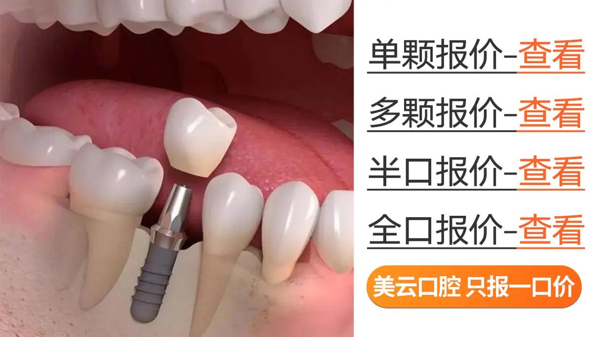 种牙单独收手术费_单个种牙价格_单颗种牙一般要多钱