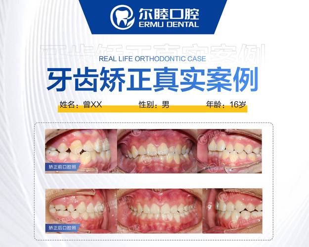 深圳龙华牙齿不齐钢丝矫正费用大概多少？
