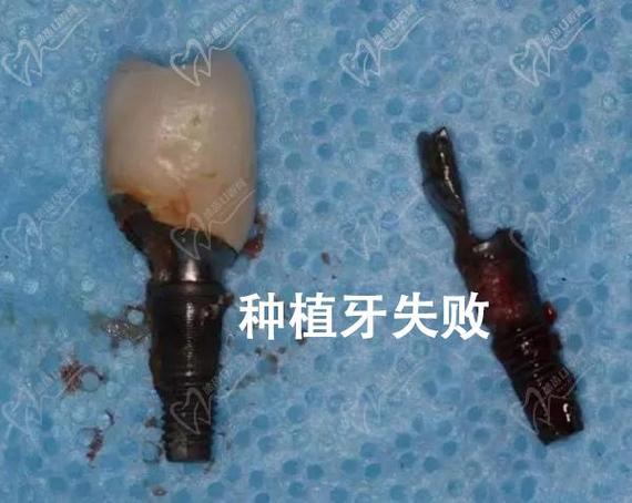 深圳福田单颗种植牙哪家医院靠谱？看这里就对了！