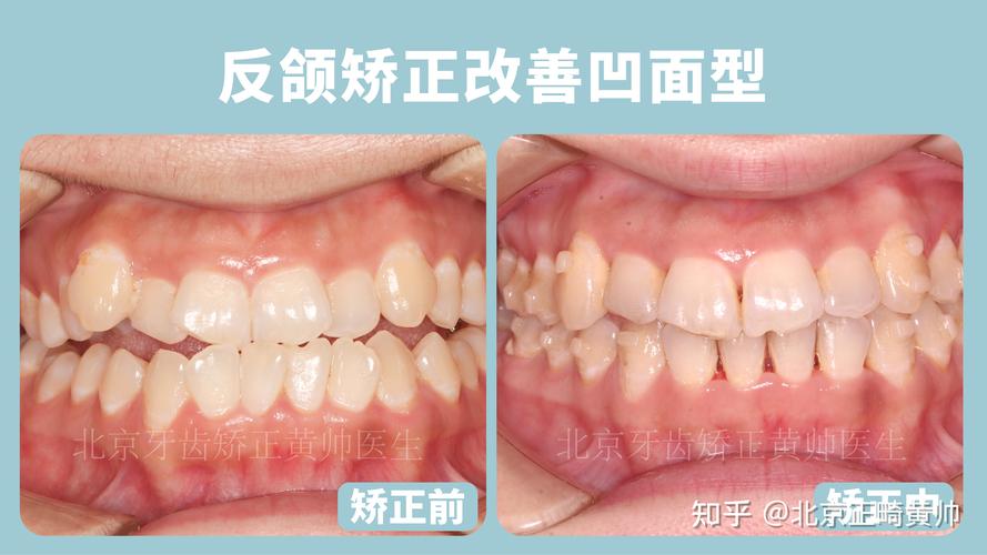 深圳正畸价格_深圳治疗地包天哪家医院好_深圳福田成人地包天正畸医院