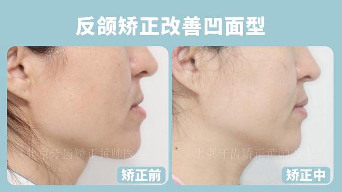 深圳治疗地包天哪家医院好_深圳正畸价格_深圳福田成人地包天正畸医院