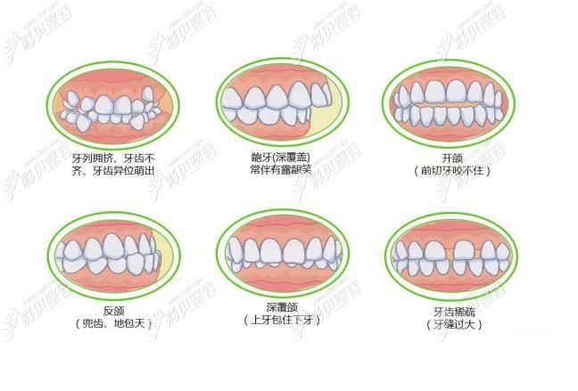 南阳矫正牙齿最好的医院_南阳牙齿矫正多少钱_南阳牙齿矫正哪里最好