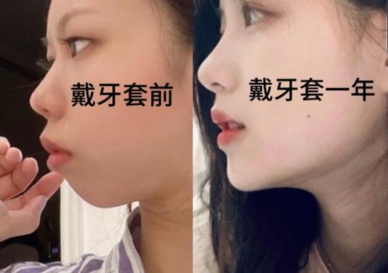 牙齿矫正可以走医保么_牙齿做矫正能走医保吗_郴州哪里可以做牙齿矫正