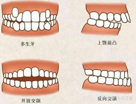郴州哪里可以做牙齿矫正_牙齿做矫正能走医保吗_牙齿矫正可以走医保么