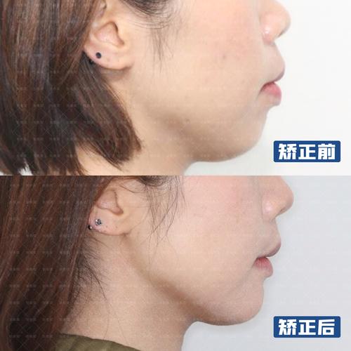 30多岁做牙齿矫正晚吗？成人正畸的真相赶紧看