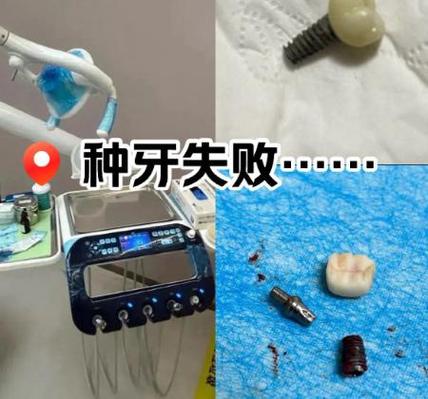 欧美种植牙品牌 ITI / 诺贝尔 费用 2026_诺贝尔种牙的三个型号的区别_诺贝尔牙科种植牙多少钱