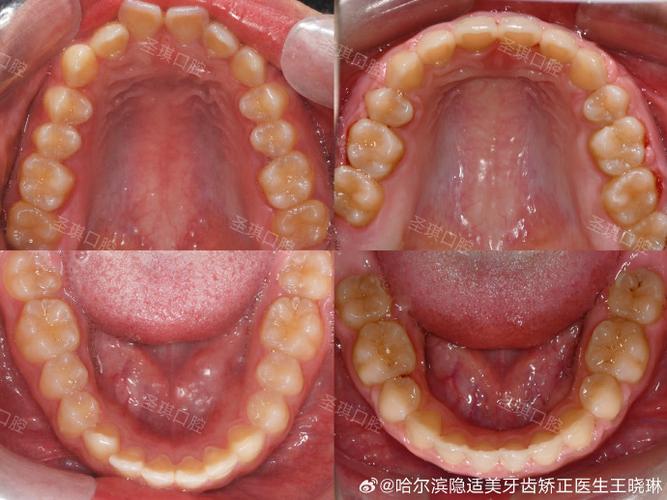 矫正龅牙有什么坏处吗_34岁龅牙矫正_矫正龅牙的最佳年龄