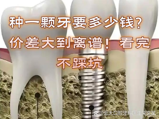 滨州种植牙多少钱一颗_滨州种植牙多少钱_种植牙费用明细