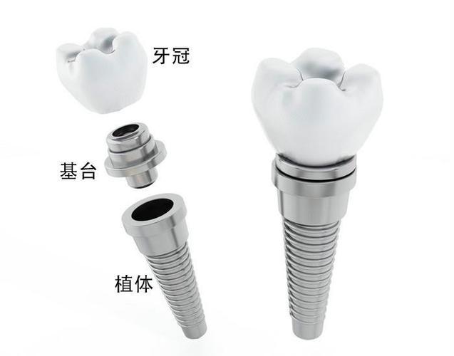 种植牙费用明细_滨州种植牙多少钱_滨州种植牙多少钱一颗