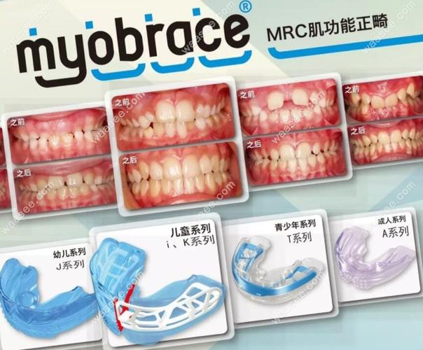 深圳南山儿童隐形MRC矫正费用_深圳隐形牙齿矫正_深圳隐形矫正多少钱