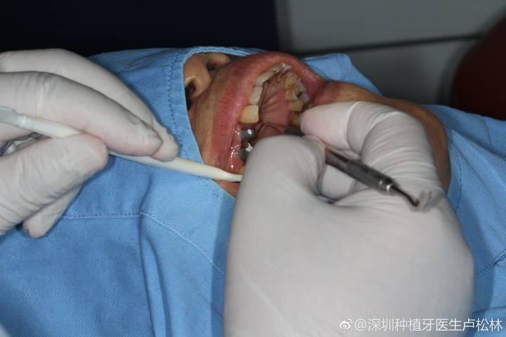 80岁还能种牙吗？医生说只要满足这个条件就能做