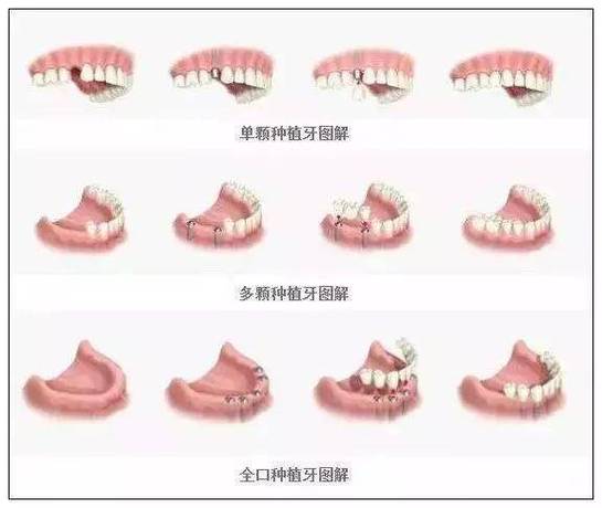 半口种植牙全过程要多久？疼不疼？一步步讲清楚
