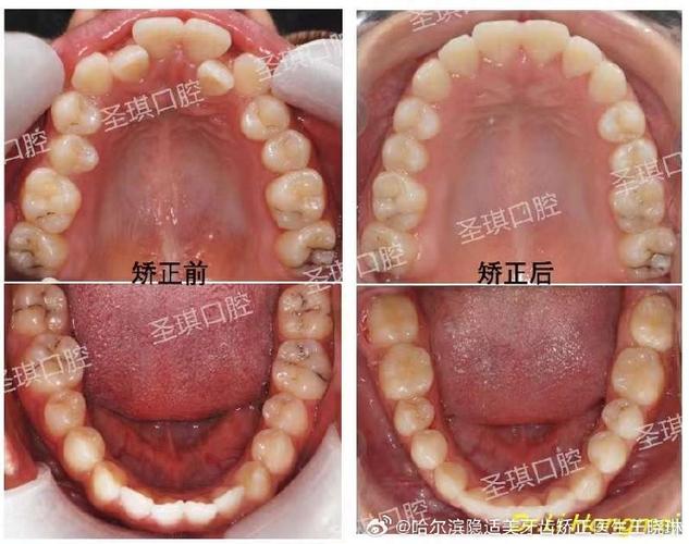 成人矫正牙齿咬合_成人牙齿咬合矫正能成功吗_成人牙齿矫正咬合多少钱