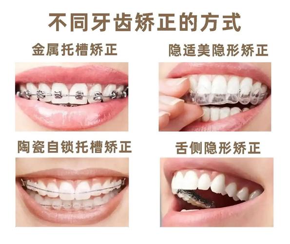 青岛整牙正畸_青岛牙齿矫正方案_青岛矫正牙齿多少钱
