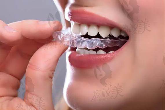 牙齿矫正做可以吃饭吗_33岁可以做牙齿矫正吗?_牙齿矫正可以只做上面吗
