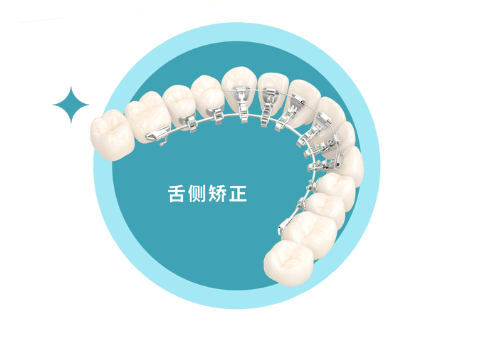 成年人牙齿舌侧正畸到底值不值？看完这几点就懂了