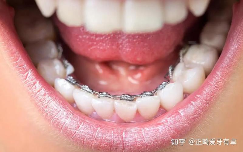 隐形舌侧正畸牙套_成年人牙齿舌侧隐形正畸_牙齿矫正是做舌侧好还是隐形好